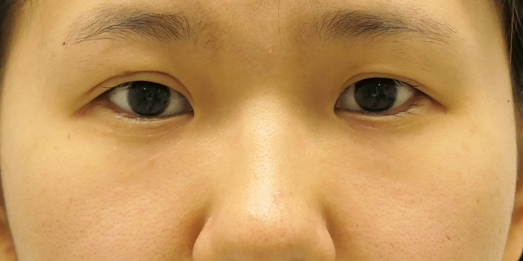 【1年後】★176　他院眼瞼下垂切開手術修正+涙袋がでて可愛くなるための経結膜脱脂術2
