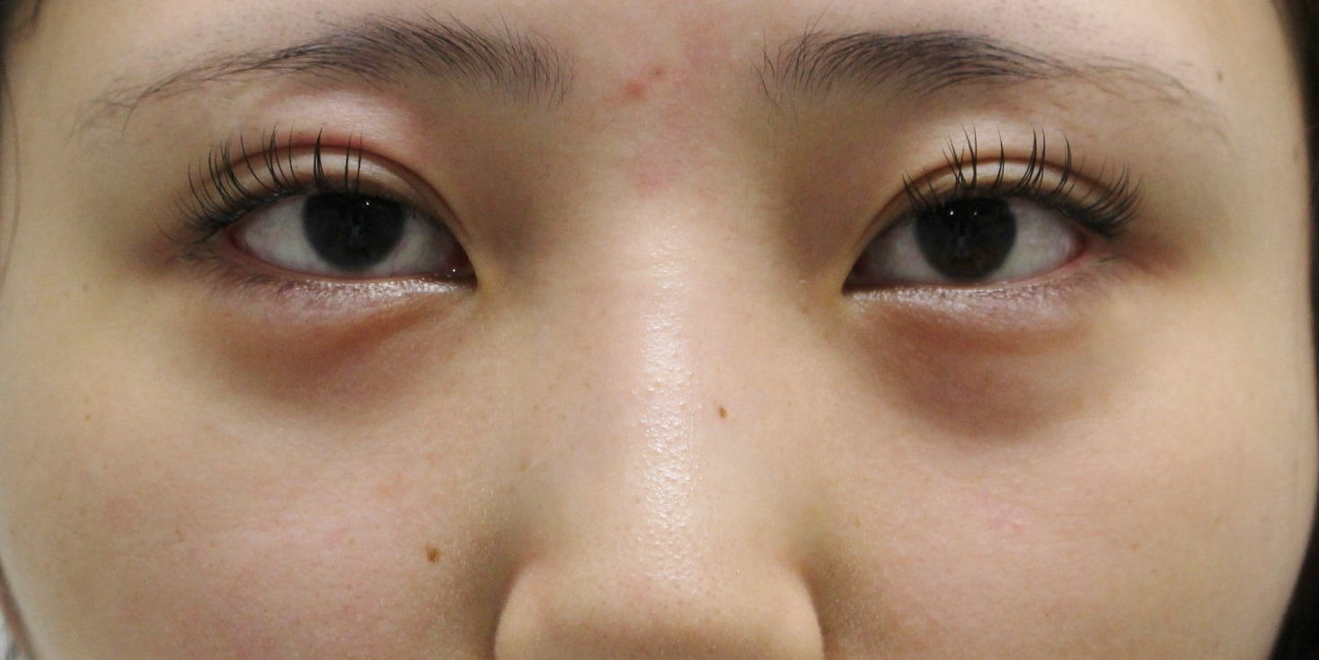 ★211　20歳女性　経結膜脱脂術+眼窩脂肪注入　他院涙袋Hy術後