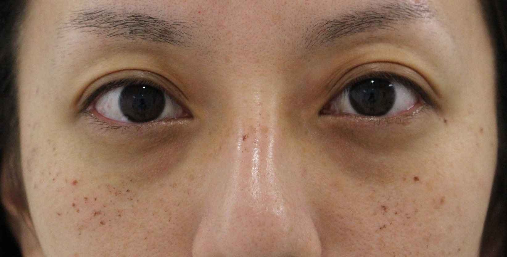 ★212　32歳女性　経結膜脱脂術+眼窩脂肪注入　瞼の皮膚色素沈着強い場合