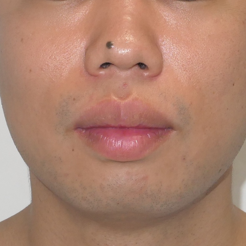 ★10　28歳男性　唇を薄くする手術　（口唇縮小（上下））　1年後まで