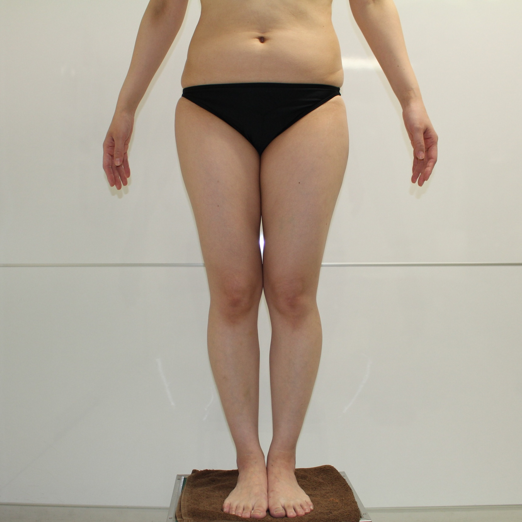 ★101　36歳女性　大腿臀部膝周りVASER・アキーセル脂肪吸引　3ヶ月まで