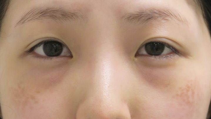 【術後3年】★89　経結膜脱脂術+眼窩脂肪注入　+目頭切開で美しい目元へ　4