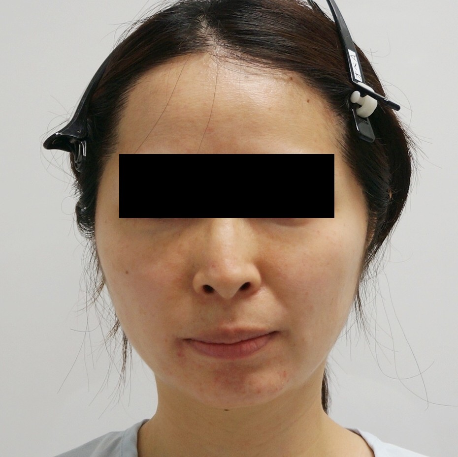 ★69【他院2回術後】36歳女性　3回めの頬アゴVASER脂肪吸引　【術後5年】
