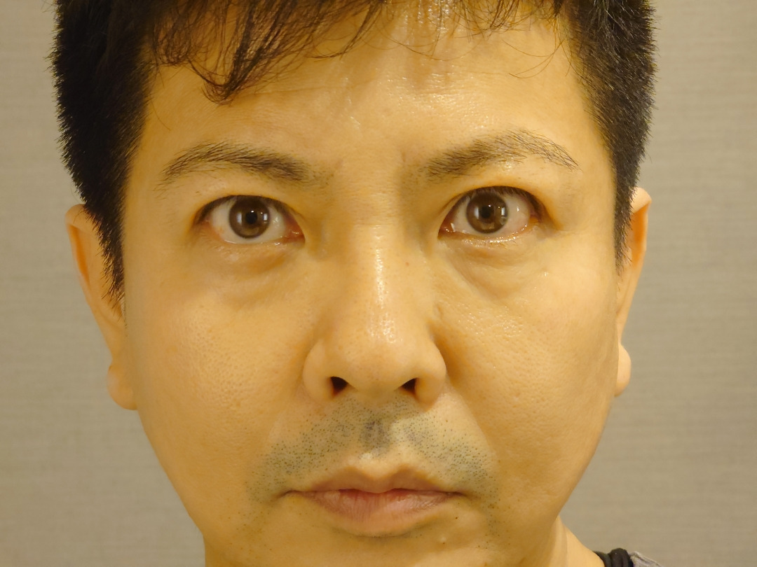新しい治療を高負荷で試してみる