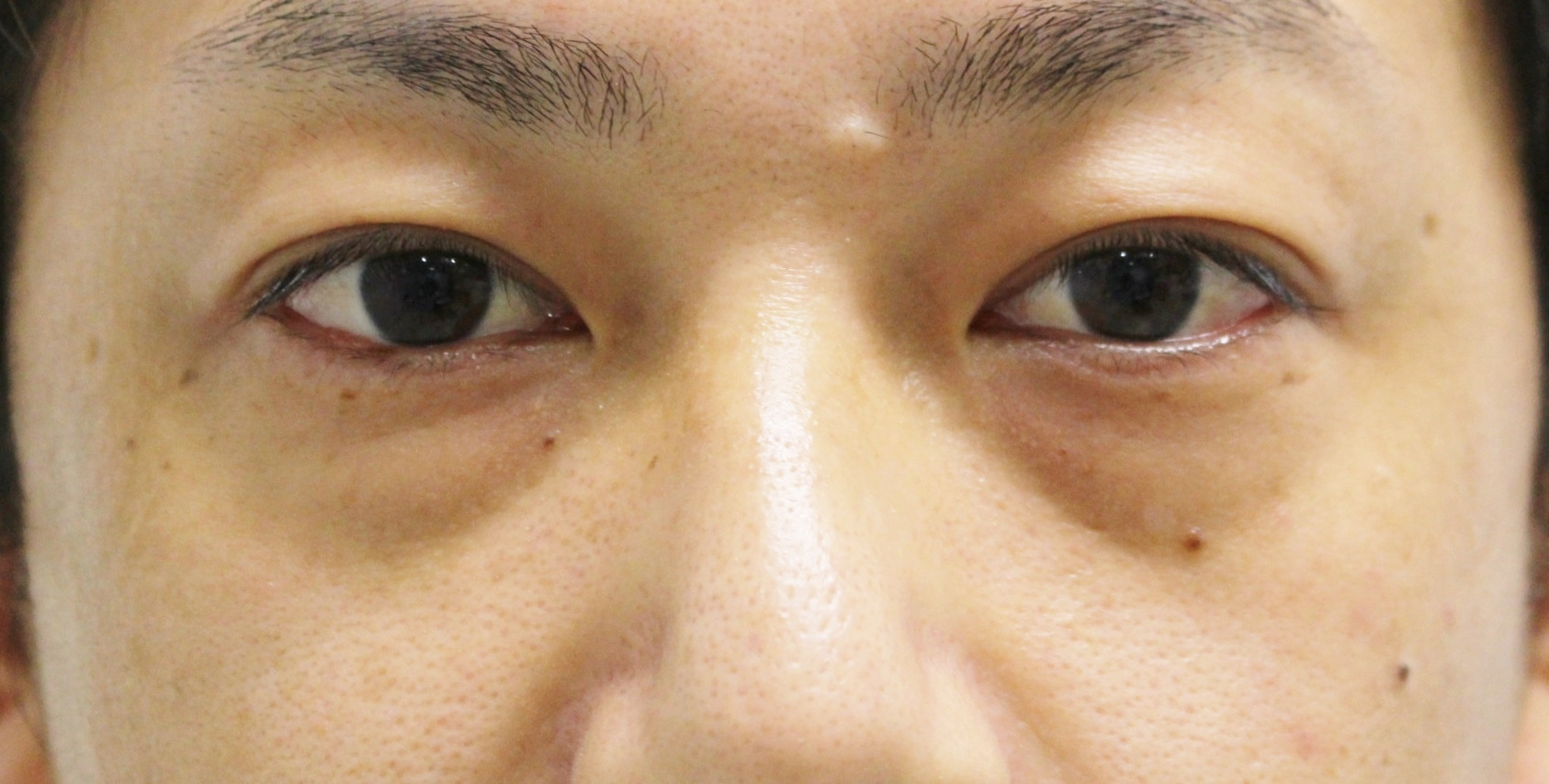 【男前アップ】★222　経結膜脱脂術+眼窩脂肪注入