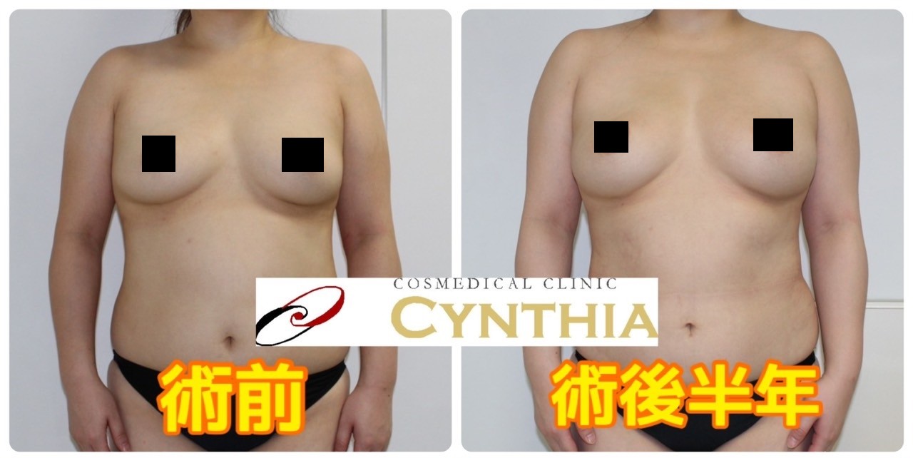 ★81 28歳女性　腹・腰・肋骨縁VASERアキーセル脂肪吸引+バストCRF