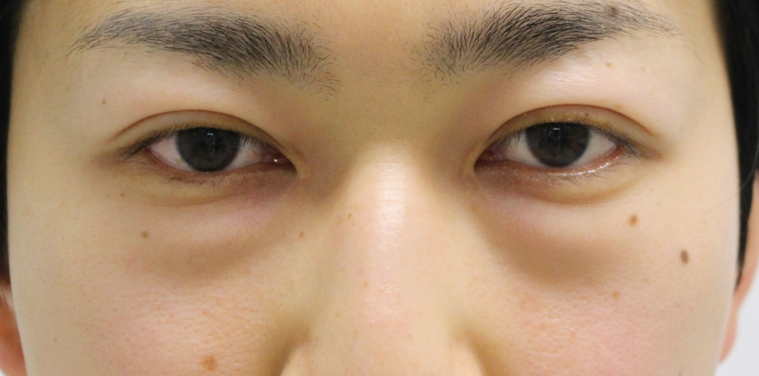 【男前アップ】★224　26歳男性　経結膜脱脂術+眼窩脂肪注入