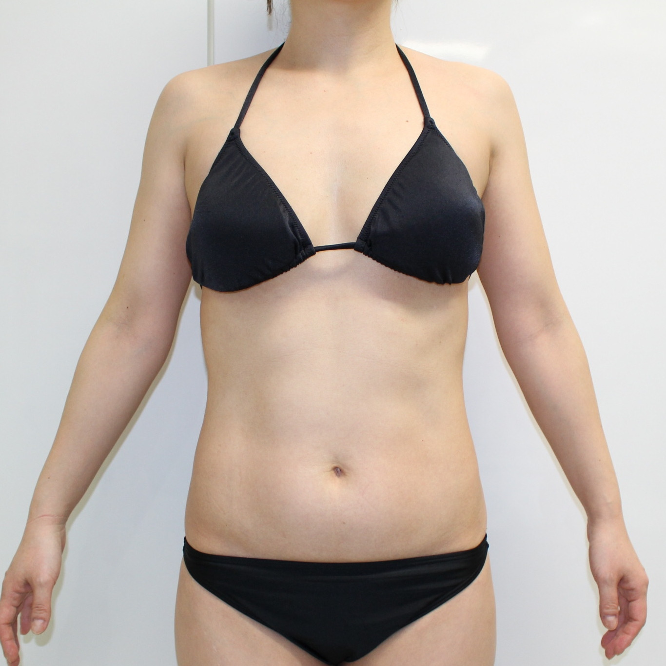 腹★75【術後1年】43歳女性　腹腰部・上腕脇後ろ肩甲骨上VASER・アキーセル+CRFバスト