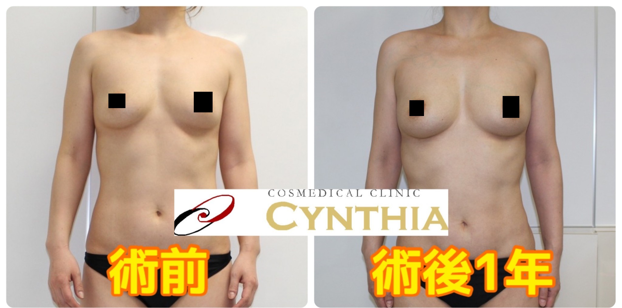 【術後1年】★76　43歳女性　腹腰部・上腕脇後ろ肩甲骨上VASER・アキーセル+CRFバスト②