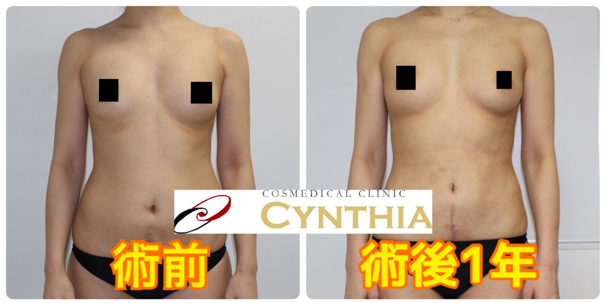 ★79-2　40歳女性　腹部腰部VASER・アキーセル+CRFバスト　術後1年まで