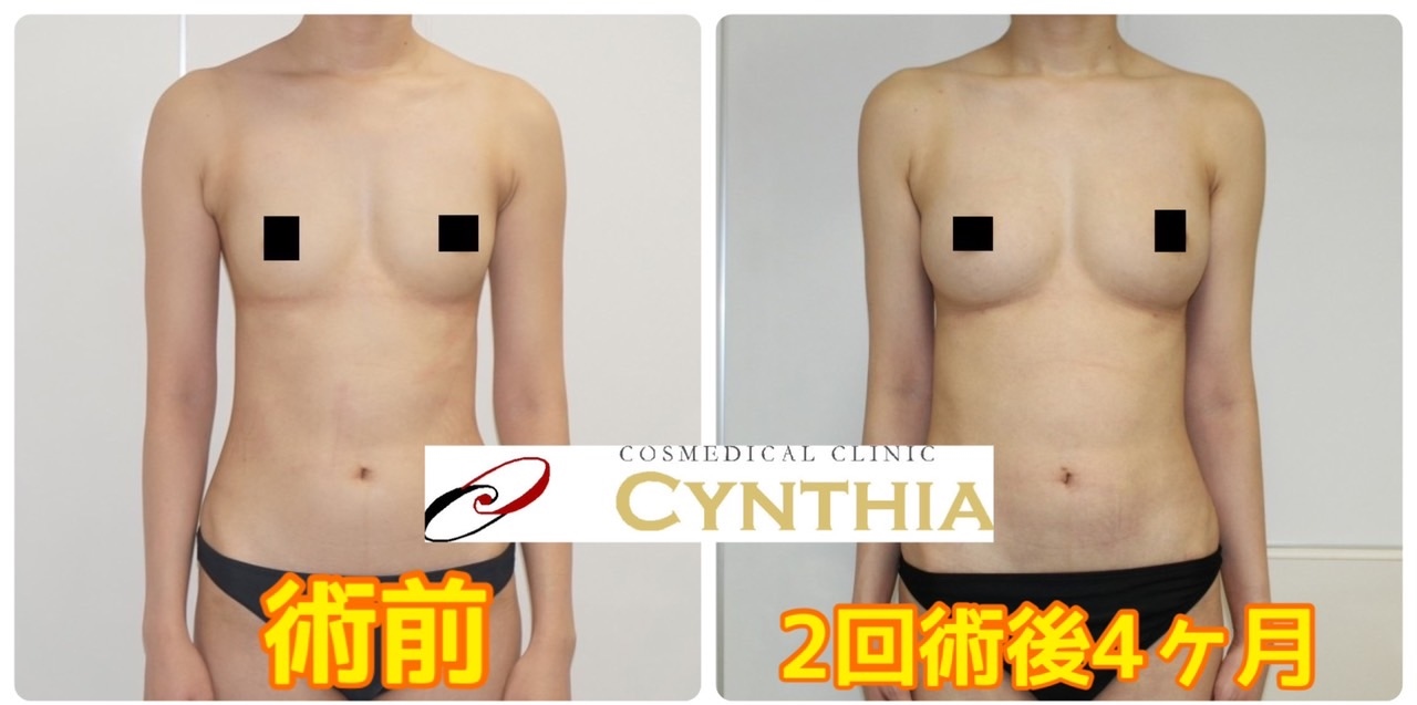 ★82　23歳女性　太ってなくても2回のCRF豊胸でしっかりとしたバストの変化