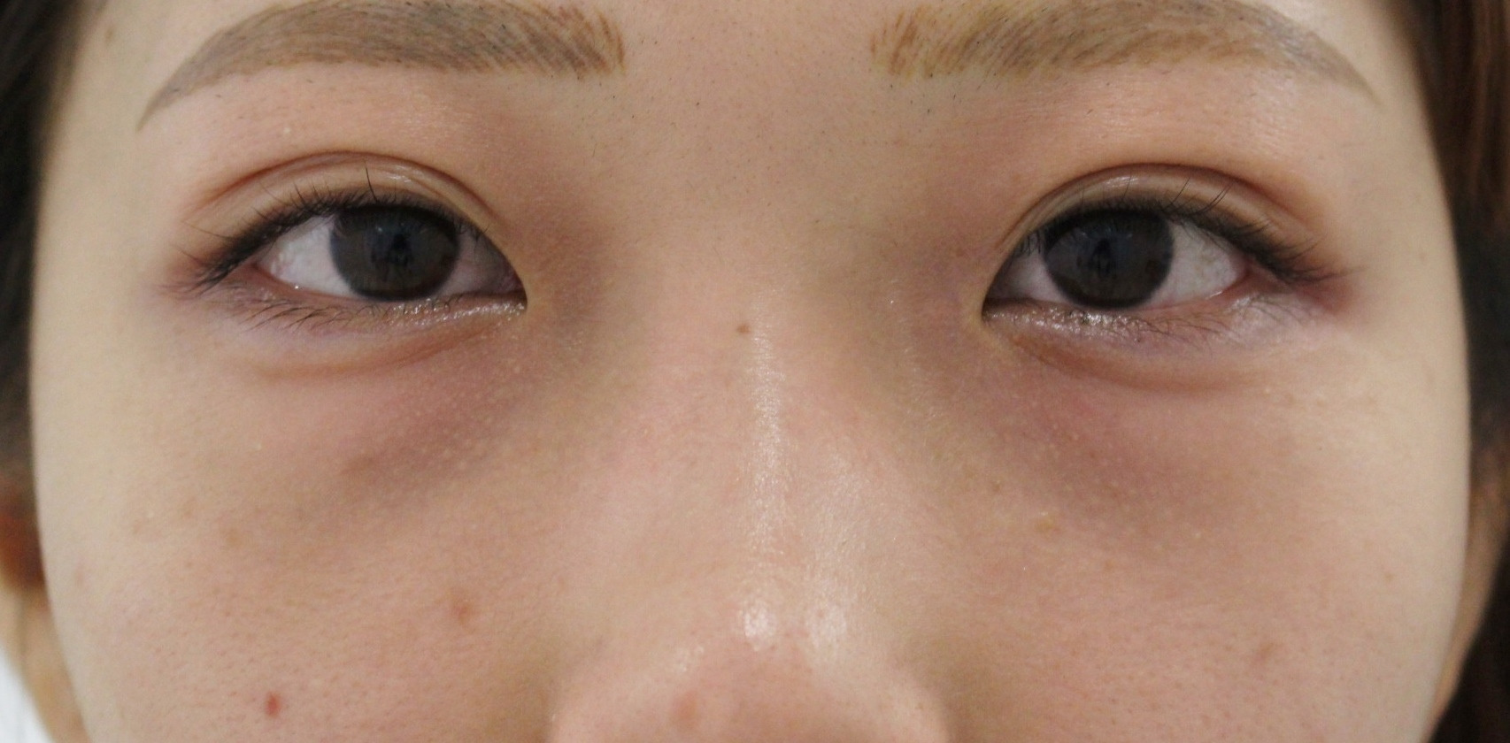 【他院で120万円！？】★229　38歳女性　経結膜脱脂術+眼窩脂肪注入