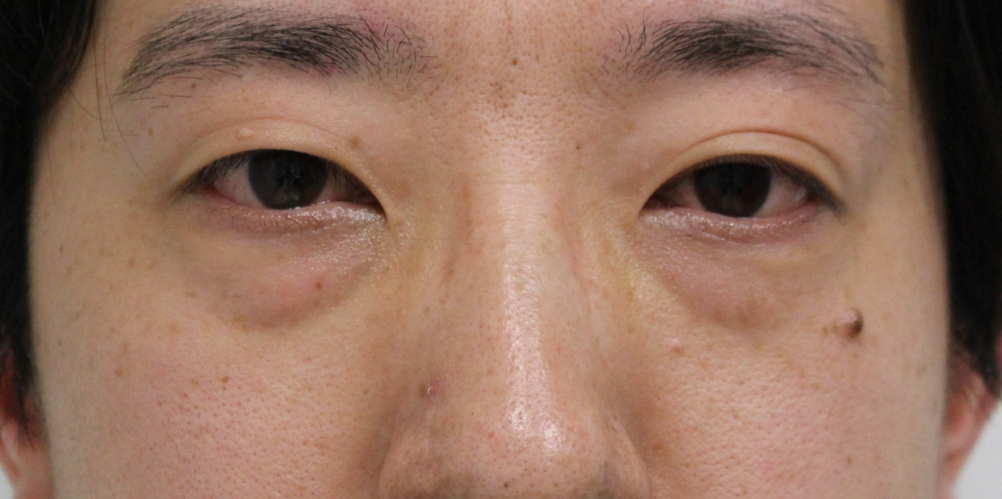 【隠れ涙袋】★234　33歳男性　経結膜脱脂術+眼窩脂肪注入+プレミアムクイック