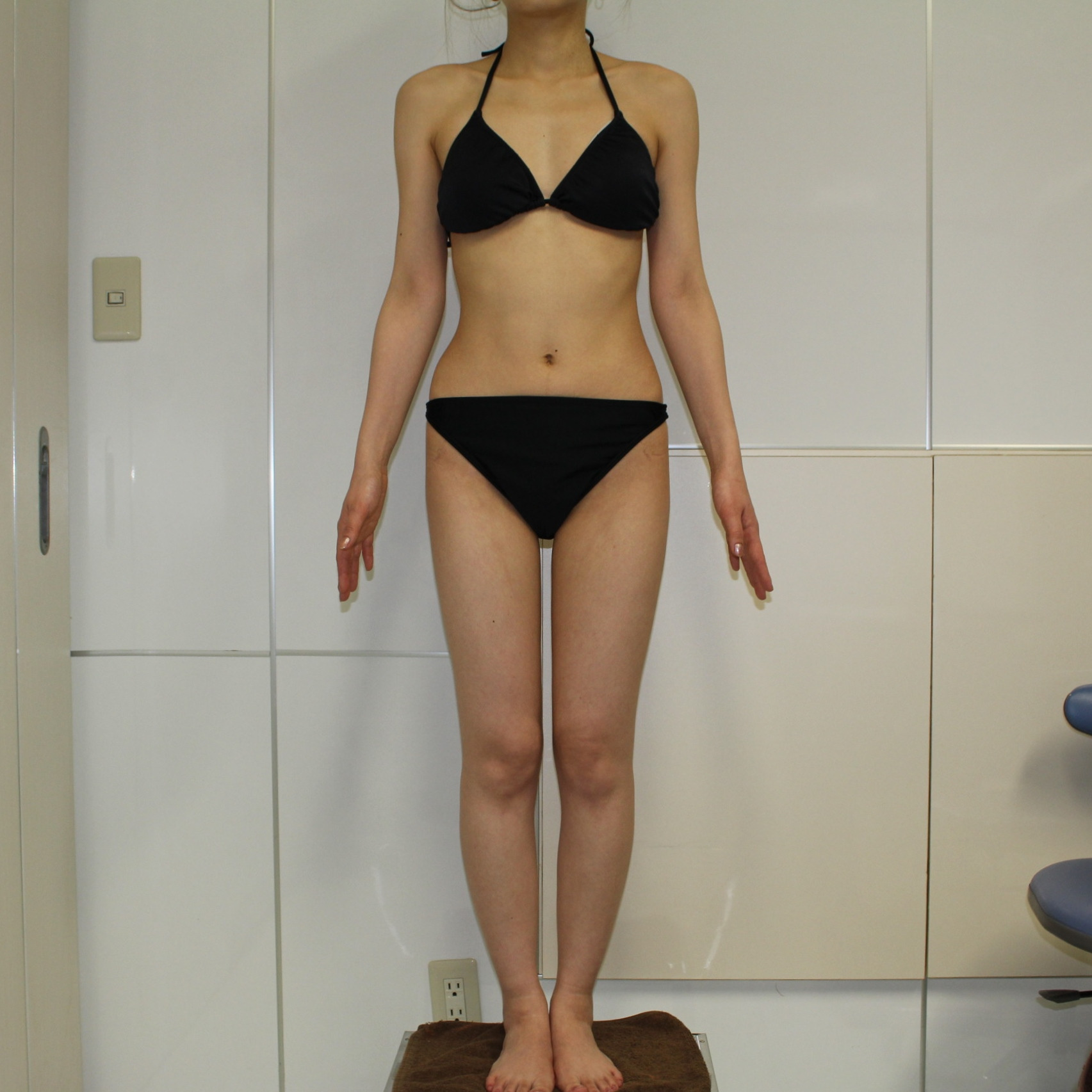 【1年後】★80-2 22歳女性 大腿臀部膝周りベイザー・アキーセル+CRFバスト　もともと脚細