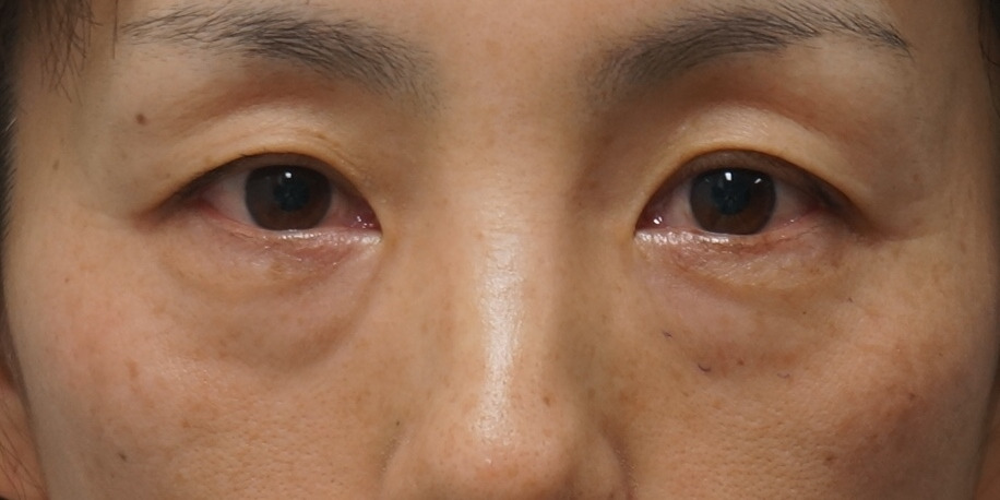 【術後6年】★51　42歳→48歳　経結膜脱脂術+眼窩脂肪注入+セミプレミアムクイック