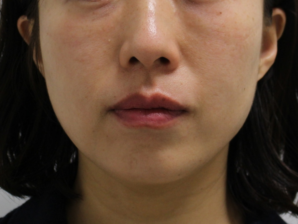 【著効】エラ小顔ボトックス4倍量（100ユニット）45歳女性【たるまない】
