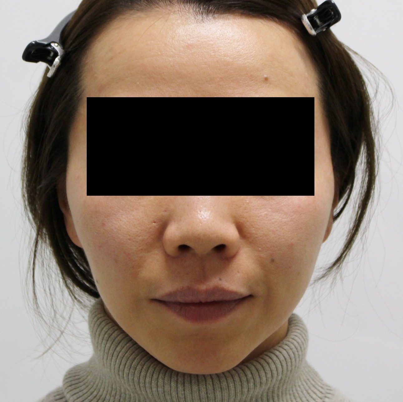 38歳女性　中顔面ヒアルロン酸（ジュビダームウルトラXC）で若々しく小顔感