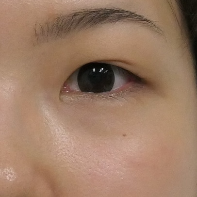 【クマ治療で蒙古ひだ】経結膜脱脂術をすると”蒙古ひだが強くなった気がする”人がいる理由
