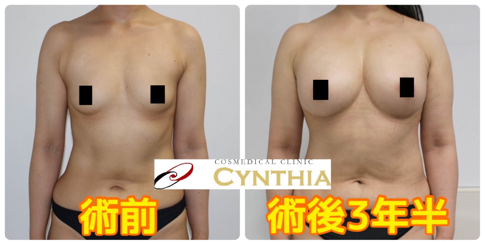 【術後3年半　Bカップ→Hカップ】★66　40歳女性　劇的変化のCRFバスト　