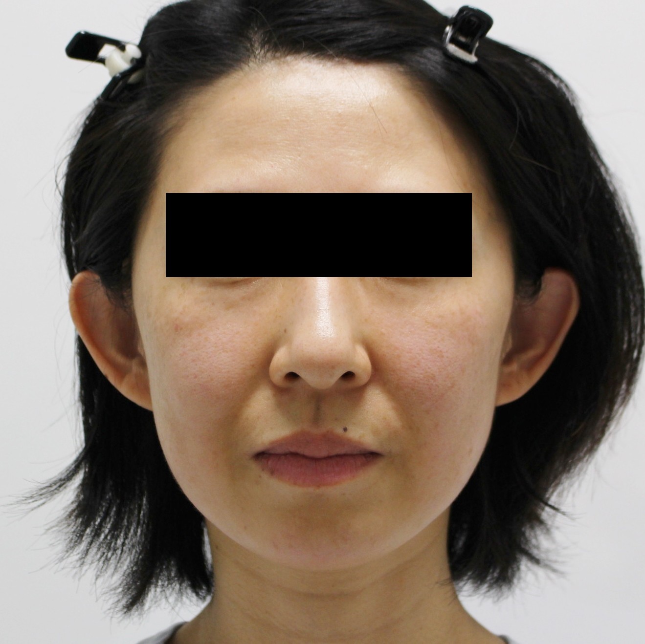 【切らないフェイスリフト】★156　40歳女性　経結膜脱脂術+VASERアキーセル+脂肪注入