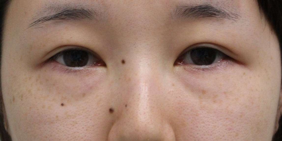 【隠れ涙袋】★242　26歳女性　経結膜脱脂術+眼窩脂肪注入