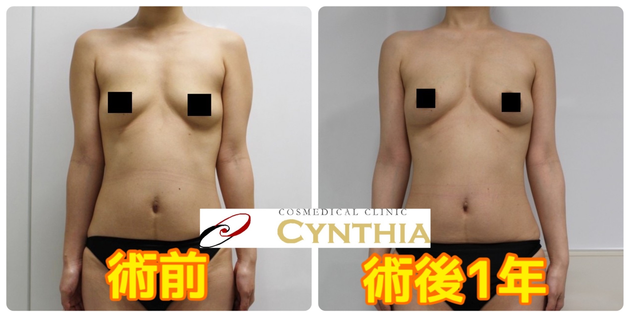 ★84　31歳女性　二の腕ワキ前後～肩甲骨上・背中下・腰VASERアキーセル+CRFバスト