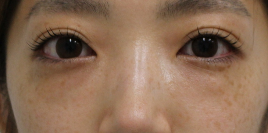 【他院 不自然目の下HY修正】★246 29歳女性 経結膜脱脂術+眼窩脂肪注入+ヒアルロニダーゼ