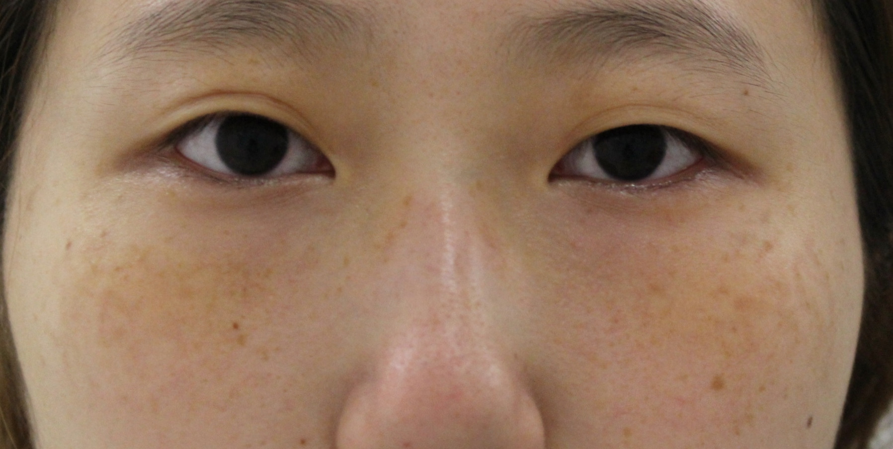 【隠れ目袋・隠れ涙袋】★256　22歳女性　経結膜脱脂術+眼窩脂肪注入+プレミアムクイック