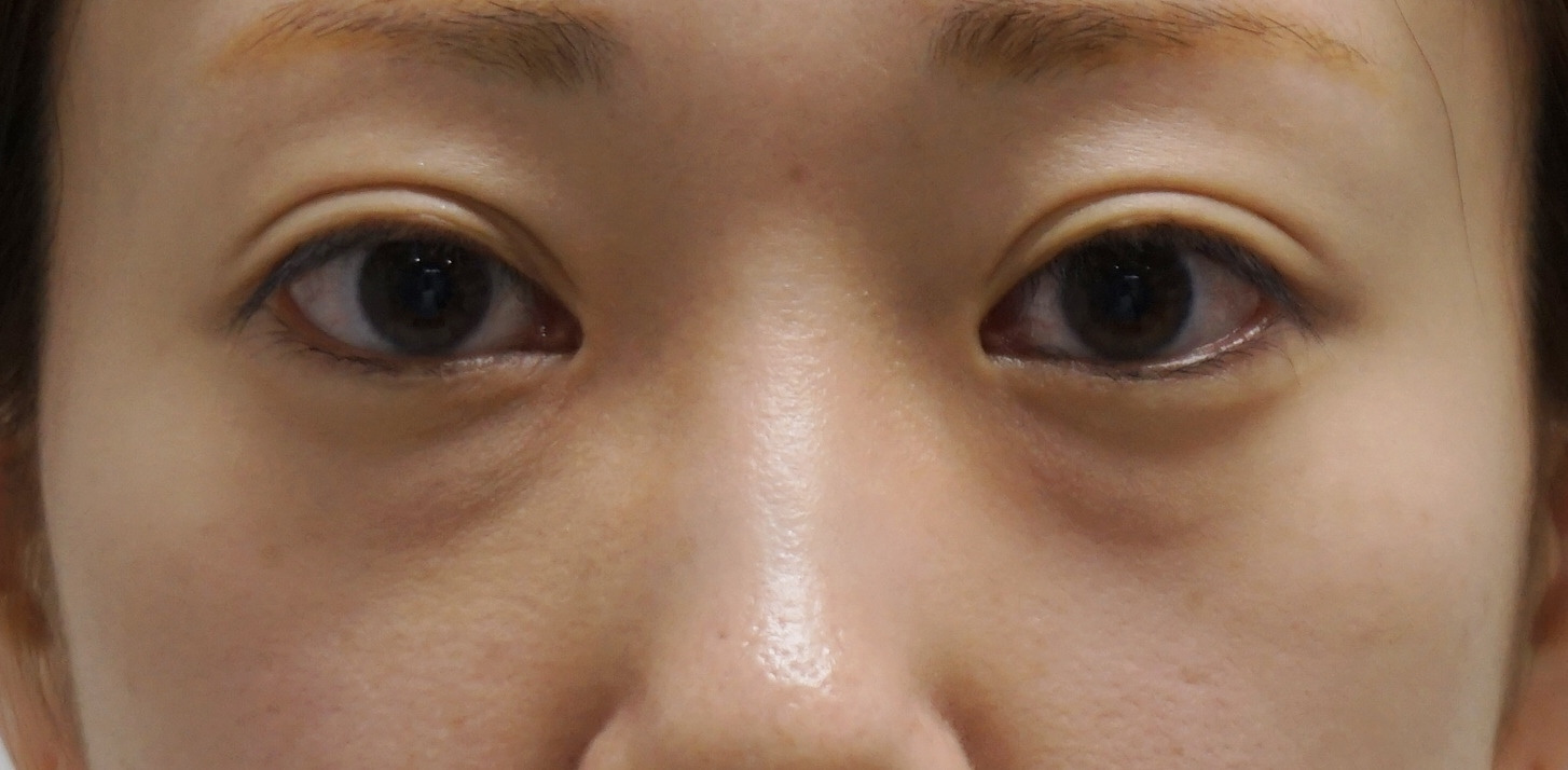 【術後4年】★83-2　　32歳女性 経結膜脱脂術+眼窩脂肪注入　疲れ顔にサヨナラ