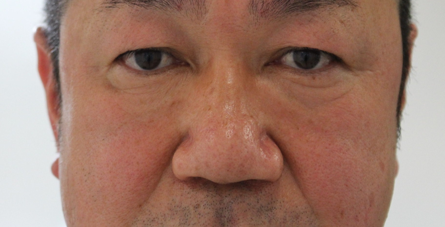 【不自然なヒアルロン酸溶解】★258　51歳男性　経結膜脱脂術+マイクロCRF