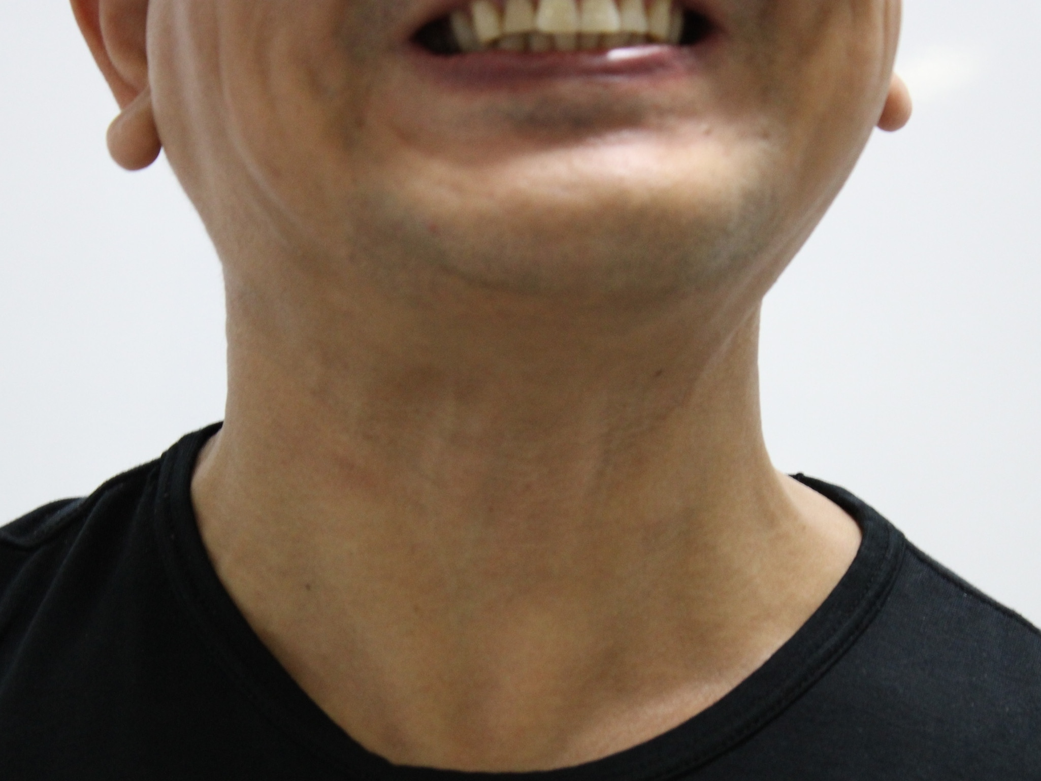 ネックボトックス　1週間
