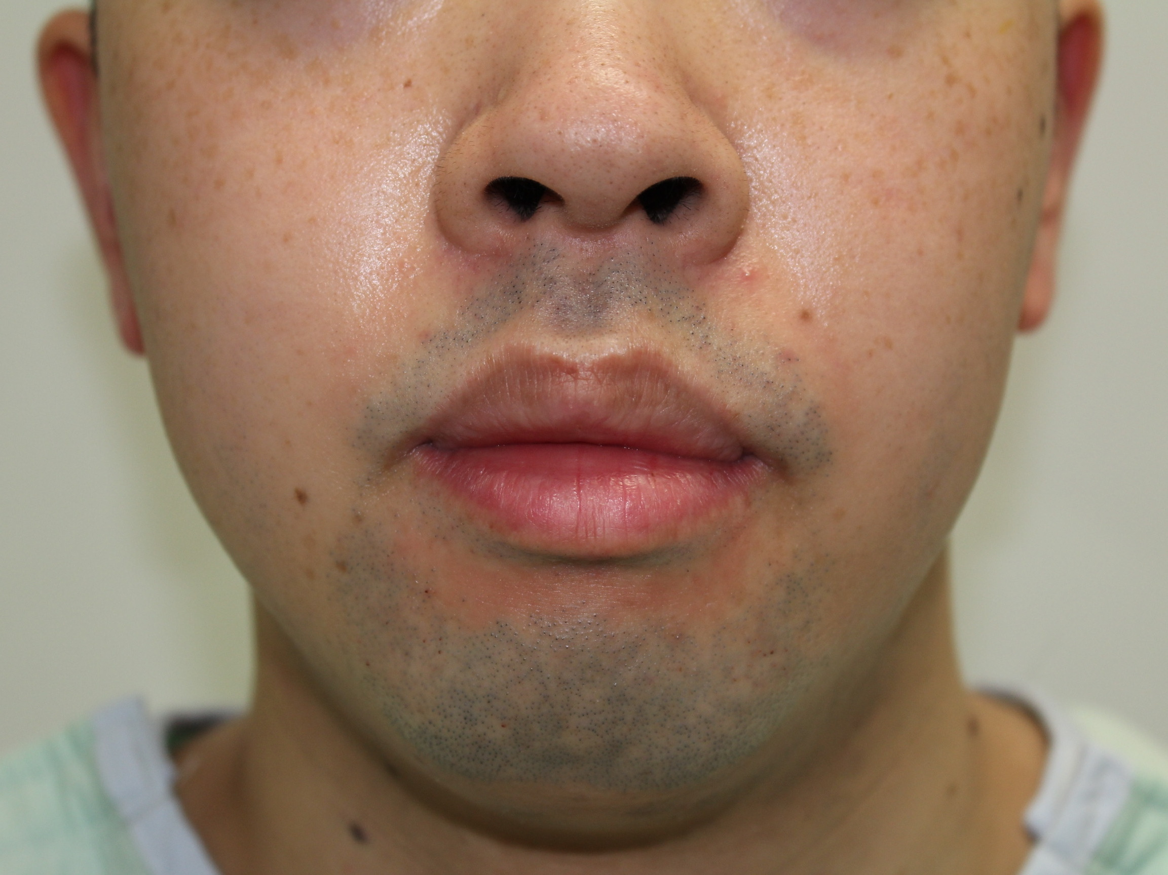 ★12　28歳男性　唇を薄くする手術（口唇縮小（上下））　術後3ヶ月