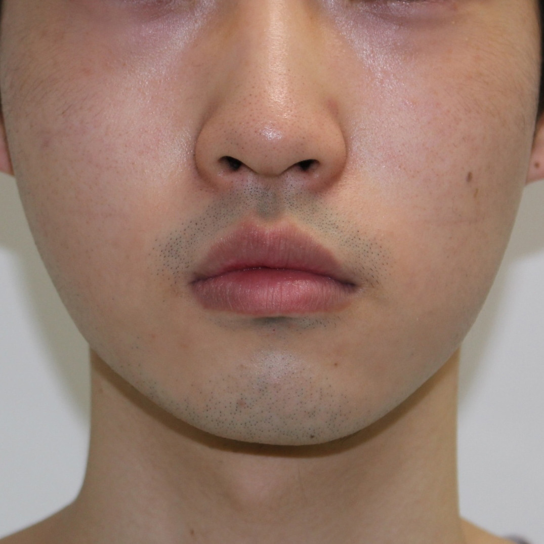 ★13　22歳男性　唇を薄くする手術（口唇縮小（上下））　術後3ヶ月