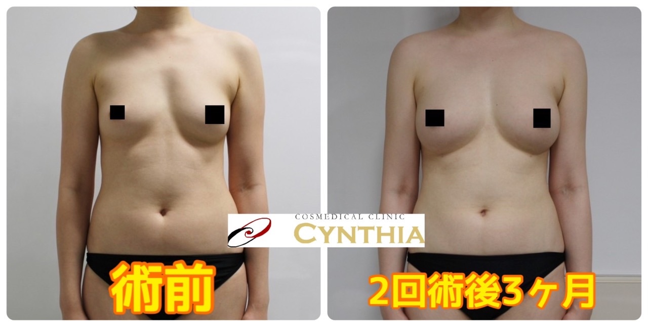 ★87　30歳女性　大腿臀部膝周り・二の腕周り、下背・腰Vaserアキーセル脂肪吸引+CRFバスト