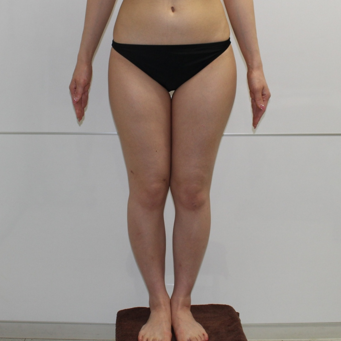 大腿★102　31歳女性　大腿臀部膝周りベイー・アキーセル脂肪吸引+CRFバスト