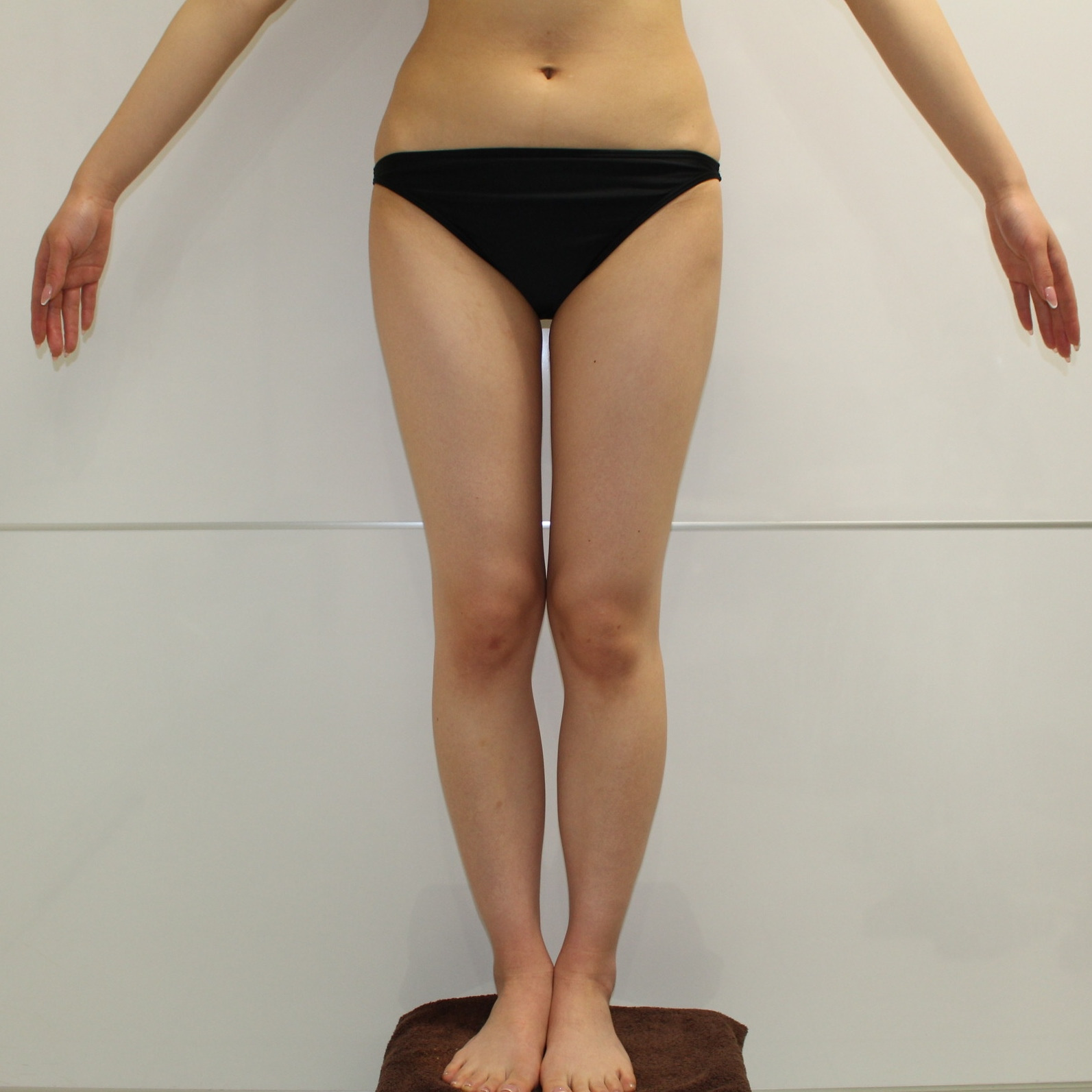 大腿★103　21歳女性 大腿臀部膝周り・二の腕周りVaserアキーセル脂肪吸引+CRFバスト