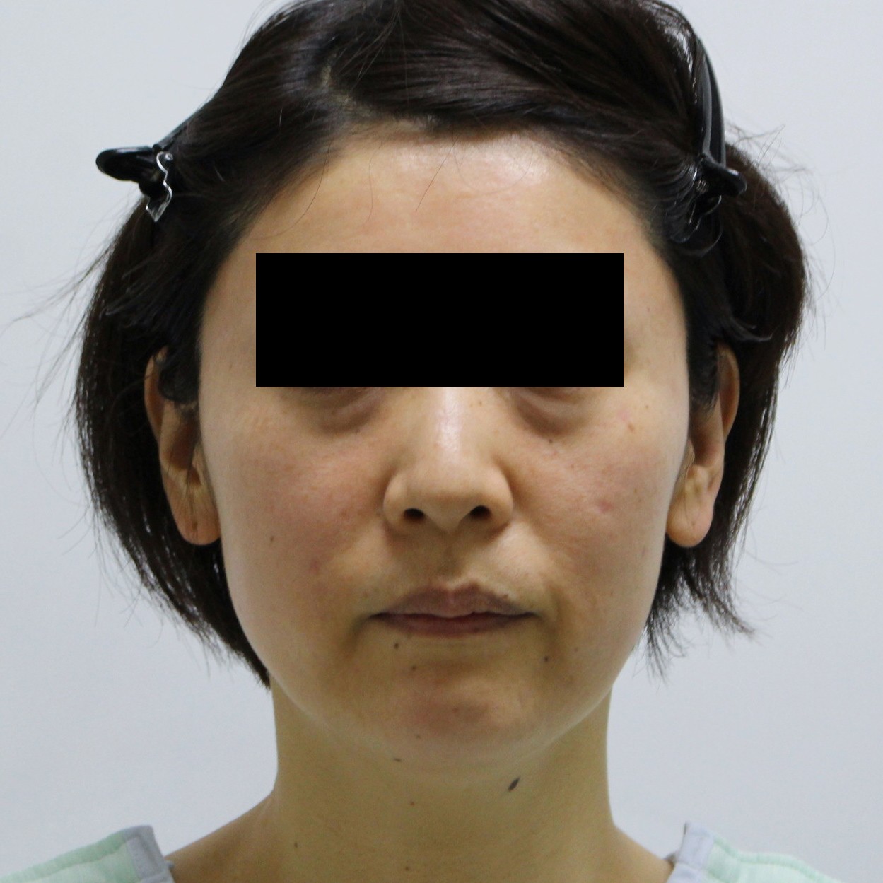 【切らないフェイスリフト】★168　頬アゴ下VASERアキーセル+経結膜脱脂術+脂肪注入