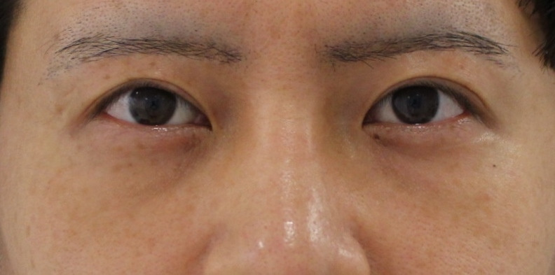 【術後1年】★272　32歳男性　経結膜脱脂術+眼窩脂肪注入　