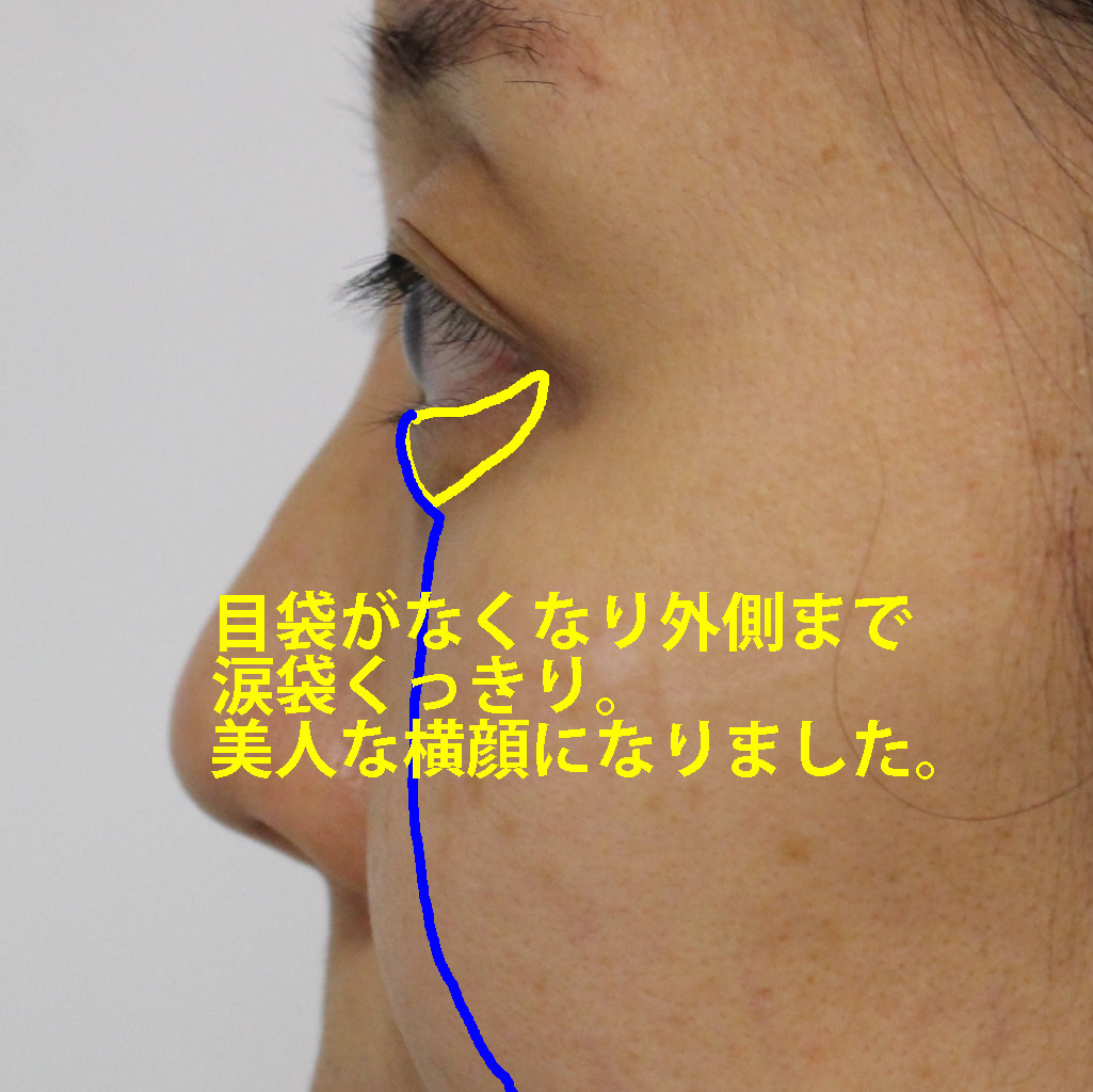 【1年後】★259-2　45歳女性　経結膜脱脂術+VASERアキーセル+脂肪注入
