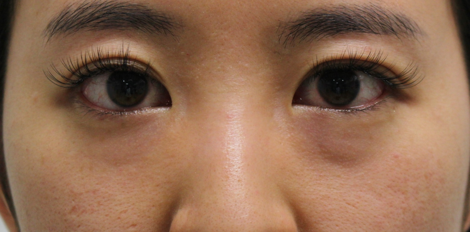 美容外科医が教えてくれない　目袋と眼球の動き（視線）の秘密