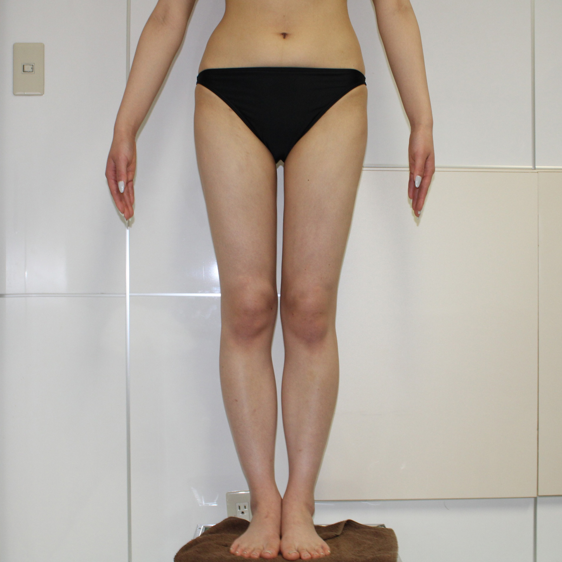 上腕●74　21歳女性 二の腕周り・大腿臀部膝周りVaserアキーセル脂肪吸引+CRFバスト