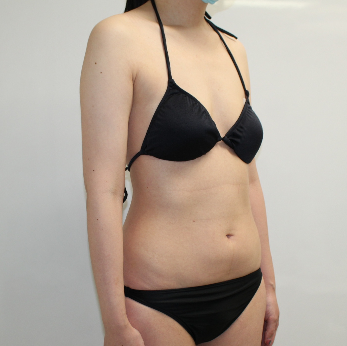 上腕●75　36歳女性　二の腕（肩）脇後ろ～肩甲骨上　ベイザー・アキーセル脂肪吸引
