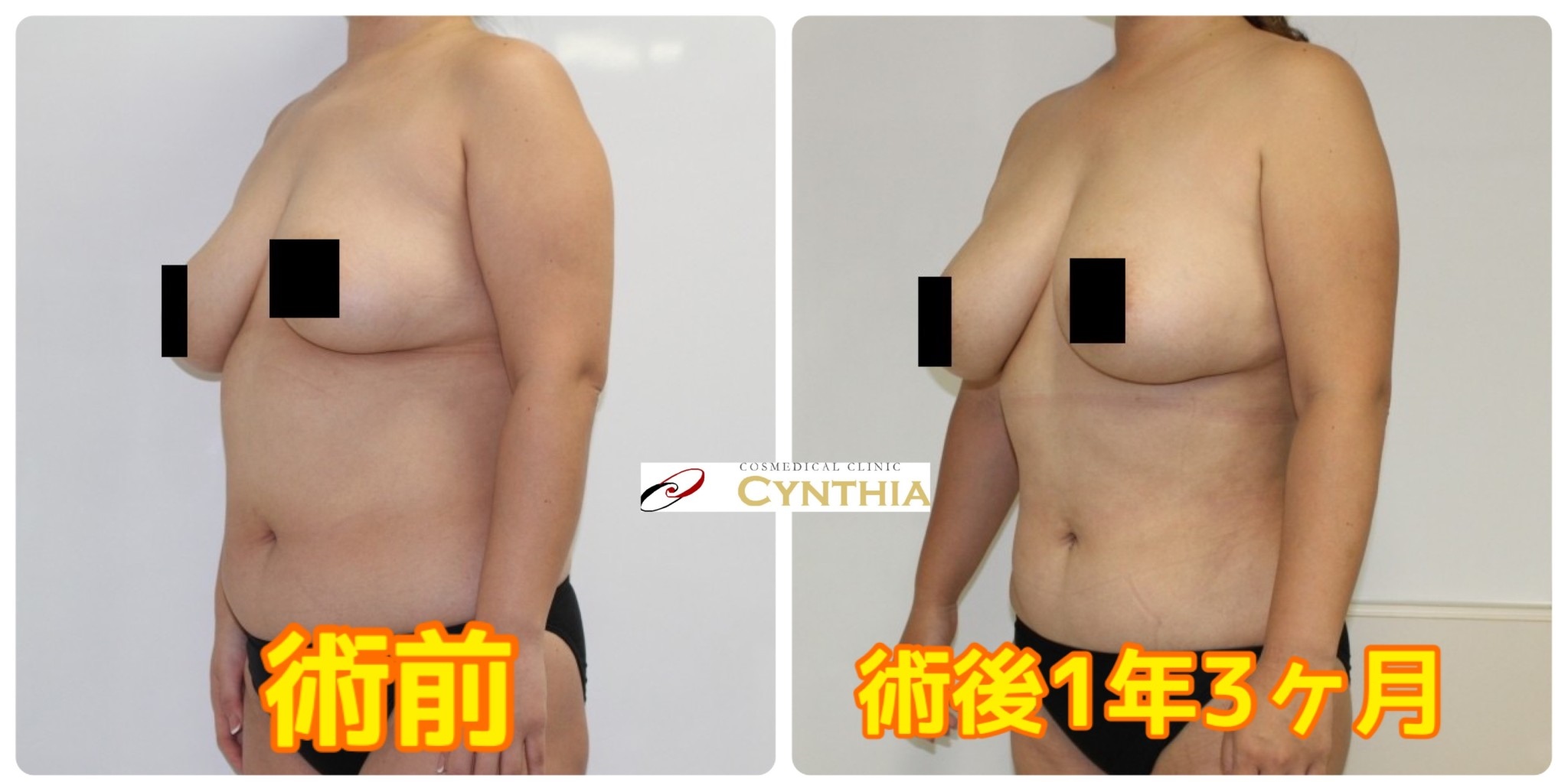 【術後1年3ヶ月】★90　39歳女性　腹腰・下背部ベイザーアキーセル脂肪吸引+CRFバスト