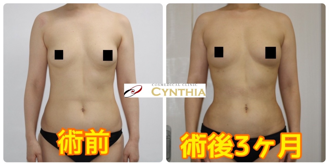★91　45歳女性　腹腰・下背部VASERアキーセル脂肪吸引+CRF豊胸