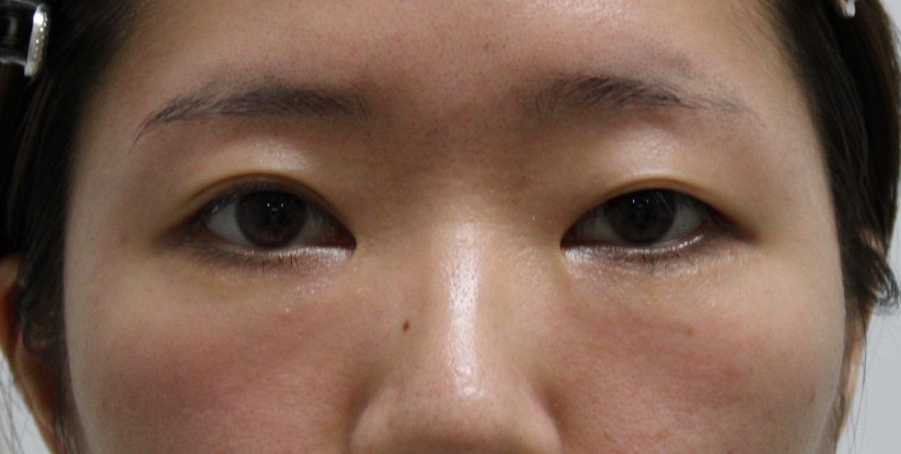 ★280　26歳女性　経結膜脱脂術+眼窩脂肪注入　プレミアムクイック+マイクロカット脂肪除去