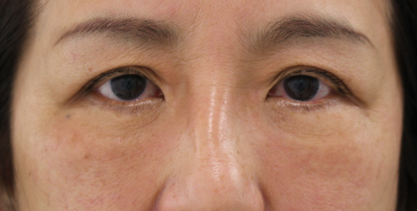☆19-2　【術後半年】57歳女性　眉下切開6ヶ月後　