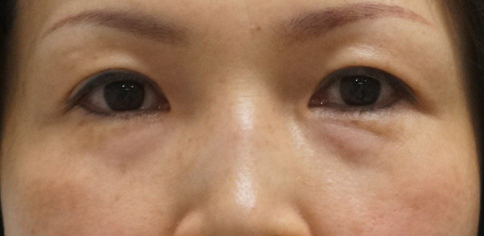 【術後5年9ヶ月】★58　50歳女性　経結膜脱脂術+眼窩脂肪注入　　