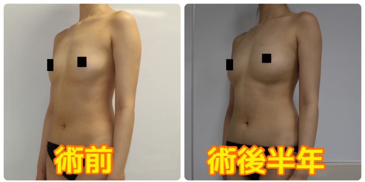 【術後半年】★86-2  21歳女性　大腿臀部膝周り・二の腕周りVaserアキーセル脂肪吸引+CRFバスト