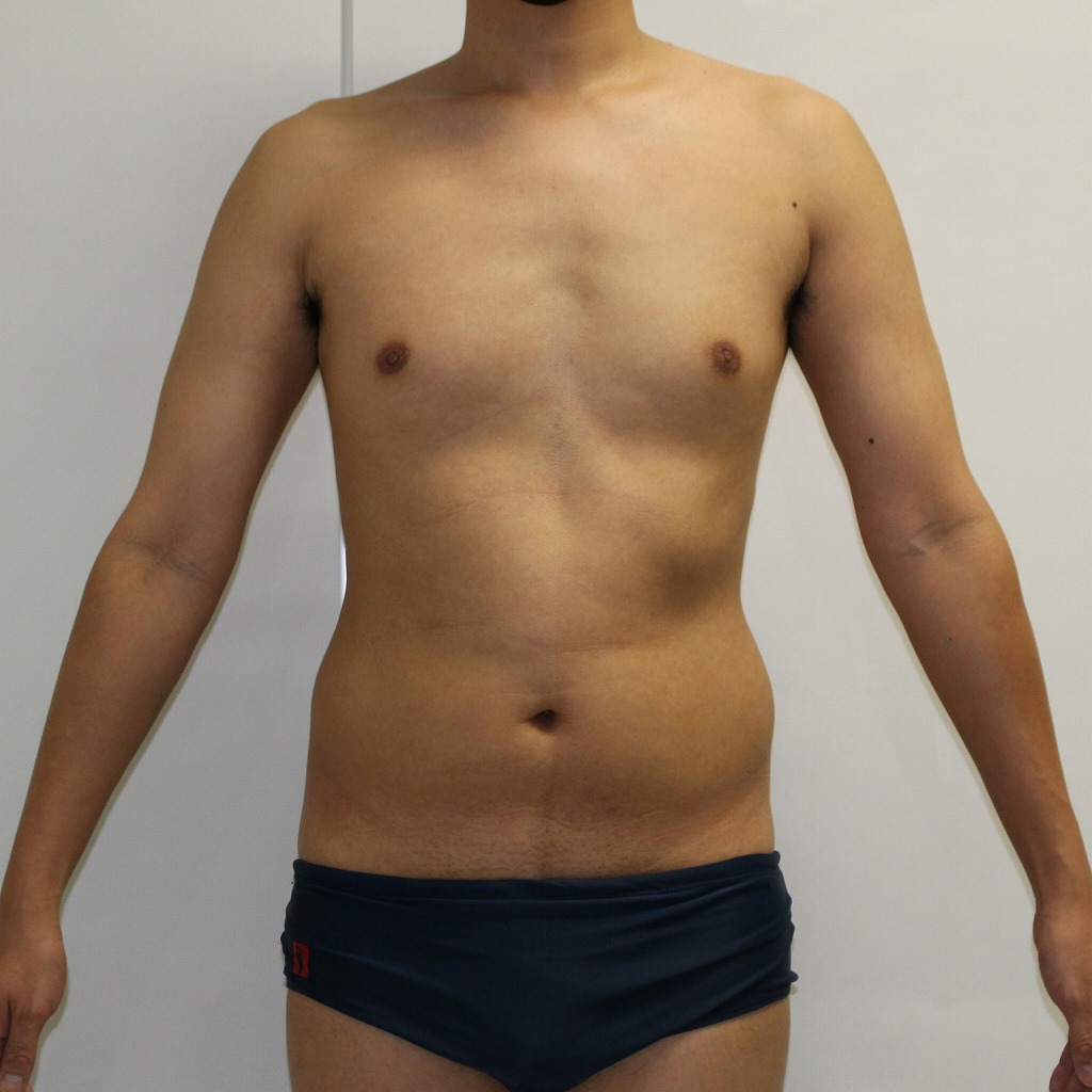 腹★79 30歳男性　腹・腰部ベイザーアキーセル脂肪吸引　術後1年まで