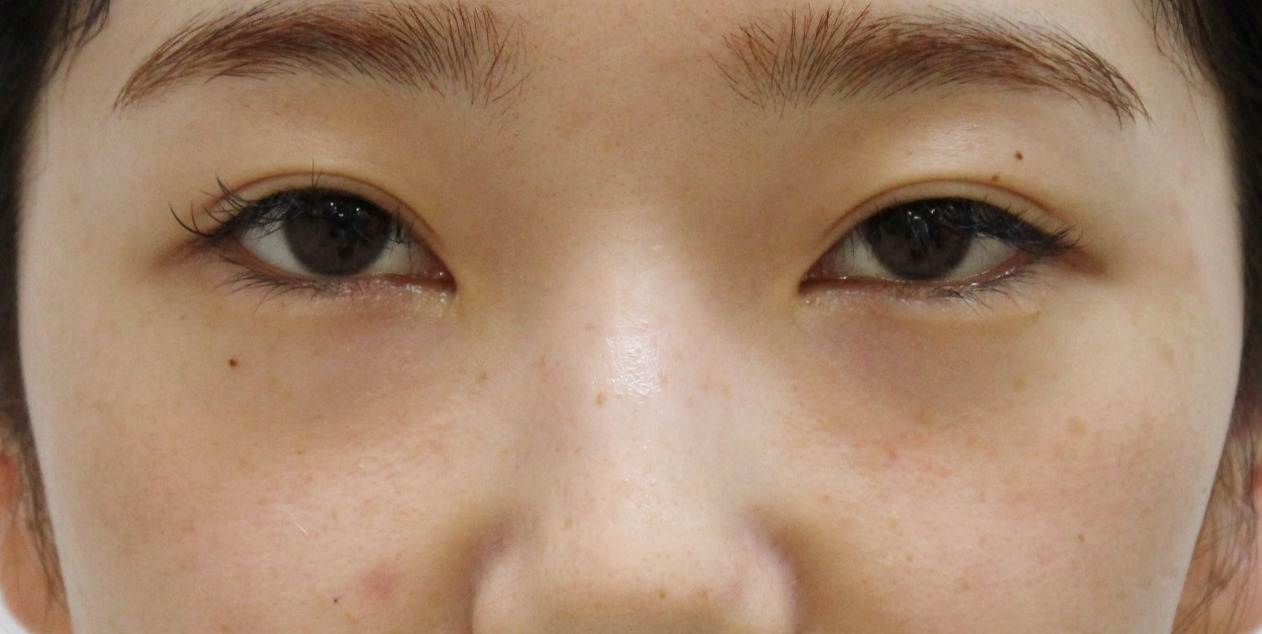 【隠れ涙袋】★296　25歳女性　経結膜脱脂術+眼窩脂肪注入